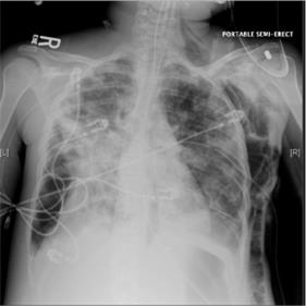 Image 1 Chest X-ray on admission