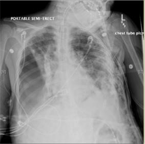Image 2 Chest X-ray 3 days after admission