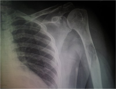 Radiology image of ribs and shoulder