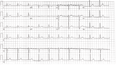 EKG Case of the Month – U Waves – The New York Medical Journal